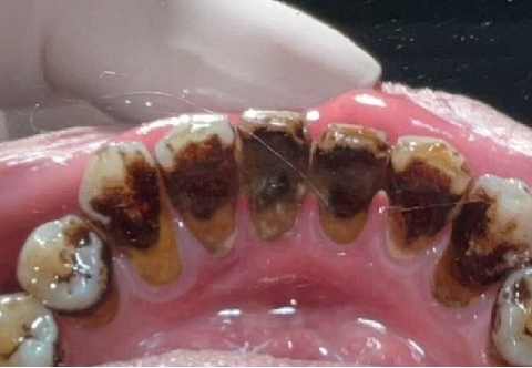 [GIẢI ĐÁP] Lấy cao răng có ảnh hưởng gì không, có tốt không